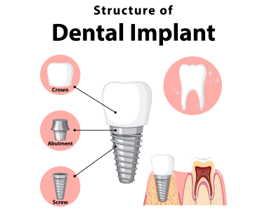Dental Implants Crystal River, FL